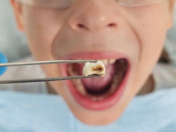 Best Emergency Dentist for Lost Fillings or Crowns in Mount Zion, GA